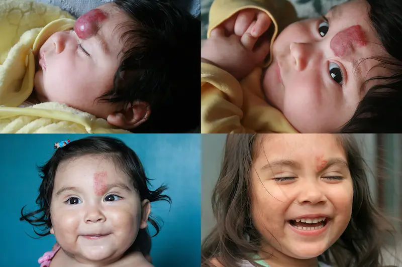 Hemangioma Types, Symptoms, Causes and Treatments